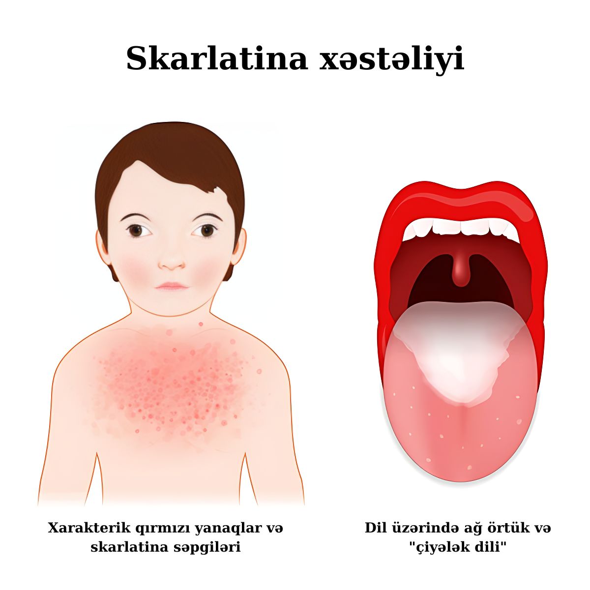 Xarakterik qırmızı yanaqlar və skarlatina səpgiləri